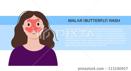 Systemic lupus erythematosus 113280957