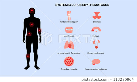 Systemic lupus erythematosus Systemic lupus erythematosus 113280964