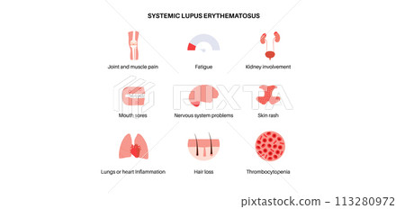 Systemic lupus erythematosus 113280972