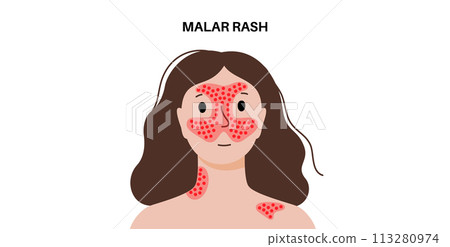 Systemic lupus erythematosus Systemic lupus erythematosus 113280974