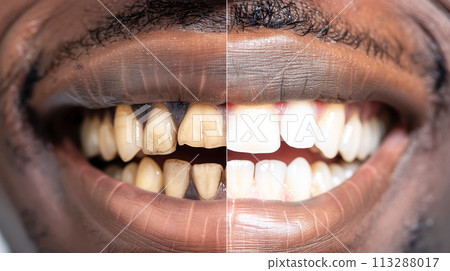 Split image of a man's teeth before and after dental treatment. Discolored and uneven teeth are transformed into a white, even and bright smile. Concept of teeth whitening or installation of veneers 113288017