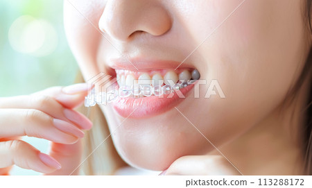 A woman puts on an invisible silicone aligner for her teeth. Bite Correction Braces Orthodontic Silicone Transparent Teeth Aligner 113288172