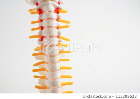 Spinal nerve and bone, Lumbar spine displaced herniated disc fragment, Model for treatment medical in the orthopedic department. 113299628