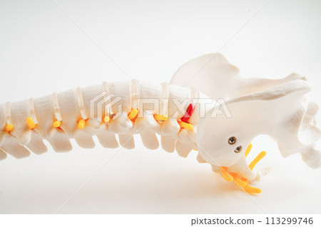 Spinal nerve and bone, Lumbar spine displaced herniated disc fragment, Model for treatment medical in the orthopedic department.. Spinal nerve and bone, Lumbar spine displaced herniated disc fragment, Model for treatment medical in the orthopedic department.. 113299746
