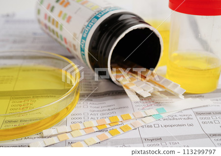 Urinalysis, urine cup with reagent strip pH paper test and comparison chart in laboratory. 113299797