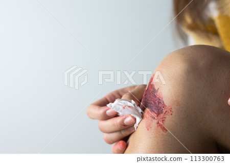 A woman caring for her bleeding knee (no face) 113300763