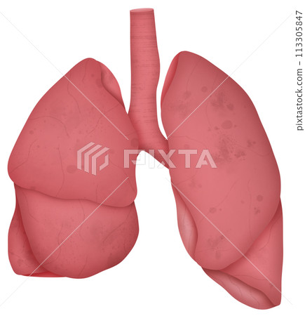 Lung 113305847