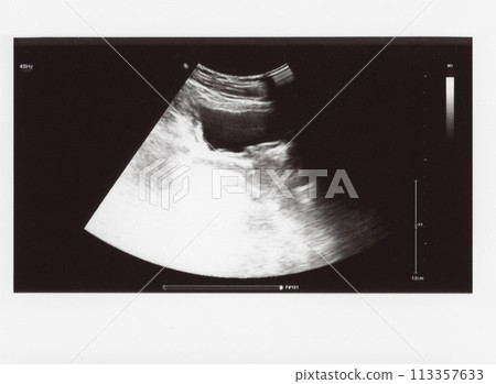 full abdomen ultrasound sonogram 113357633