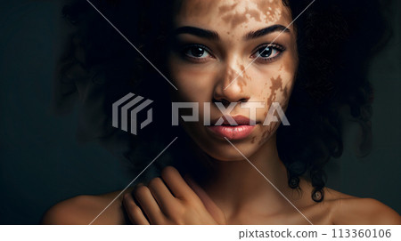 woman with vitiligo condition 113360106