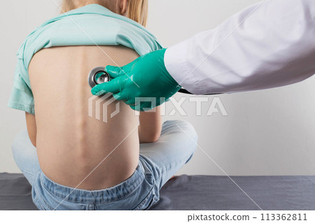 A doctor uses a stethoscope to listen to the lungs of a seven-year-old little girl. Concept of pneumonia, wheezing and bronchitis in children. Sputum discharge and cough. Treatment of viral and A doctor uses a stethoscope to listen to the lungs of a seven-year-old little girl. Concept of pneumonia, wheezing and bronchitis in children. Sputum discharge and cough. Treatment of viral and 113362811