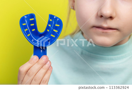 A blue dental impression tray against the background of the mouth of a seven-year-old girl. The concept of making impressions of the dental jaw for children. Correction of bite and alignment of teeth 113362924