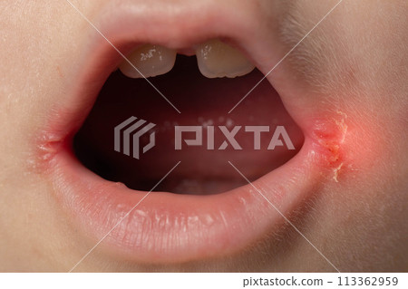 slit-like impetigo in a little girl in the corners of her mouth. Skin wounds. Dermatological bacterial disease. Sticky lips, close-up slit-like impetigo in a little girl in the corners of her mouth. Skin wounds. Dermatological bacterial disease. Sticky lips, close-up 113362959