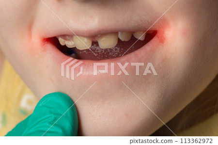 A doctor wearing medical gloves examines the mouth and lip jams of a little girl in the corners of her mouth. Bacterial and fungal infection. Herpes, close-up 113362972