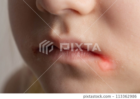 Seizures on the corners of the lips of a child s mouth. Bacterial disease of inflammation of the corners of the lips. Angular stomatitis with reduced immunity in a child, macro 113362986