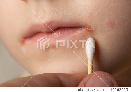 Treatment with ointment for a dermatological disease in the corners of the mouth and lips of a little girl. Treatment of seizures, herpes and angular stomatitis, slit-like impetigo, close-up 113362995