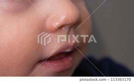 Yellow snot from a child s nose, close-up. Sinus infections, colds and virus. Chronic runny nose, adenoviruses 113363170