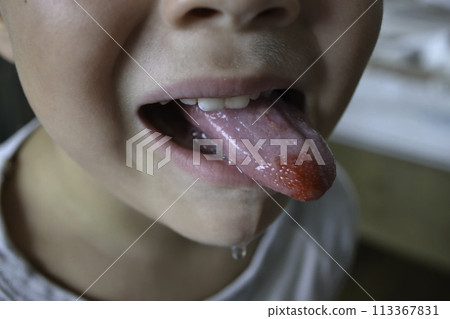 Close-up of lips, tongue, protrusion of blood. Child's bitten tongue. High quality photo 113367831