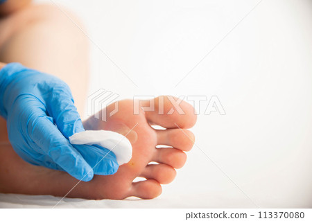 Treatment of a callus on the foot with a special solution after surgery to remove the callus and wart. Copy space for text 113370080