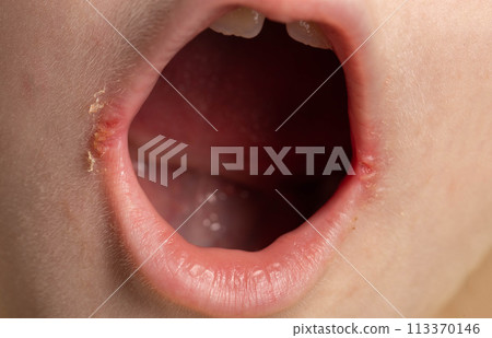 Seizures on the corners of the lips of a child s mouth. Bacterial disease of inflammation of the corners of the lips. Angular stomatitis with reduced immunity in a child, macro Seizures on the corners of the lips of a child s mouth. Bacterial disease of inflammation of the corners of the lips. Angular stomatitis with reduced immunity in a child, macro 113370146