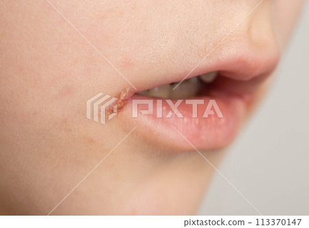 Pain and itching in the corners of the lips of a girl's mouth. Seizures on the skin, bacterial dermatological disease. Herpes infection, angular cheilitis, close-up, angulitis Pain and itching in the corners of the lips of a girl's mouth. Seizures on the skin, bacterial dermatological disease. Herpes infection, angular cheilitis, close-up, angulitis 113370147