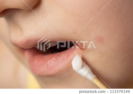 Treatment with ointment for a dermatological disease in the corners of the mouth and lips of a little girl. Treatment of seizures, herpes and angular stomatitis, slit-like impetigo, close-up Treatment with ointment for a dermatological disease in the corners of the mouth and lips of a little girl. Treatment of seizures, herpes and angular stomatitis, slit-like impetigo, close-up 113370149