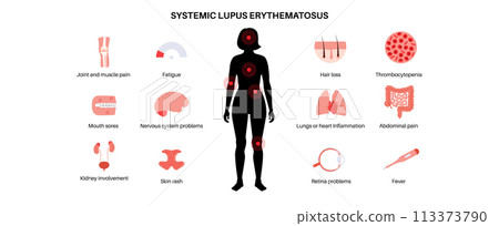 Systemic lupus erythematosus 113373790