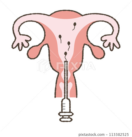 Artificial insemination illustration. 113382525