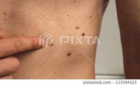 Male hand showing birthmarks on skin body stomach part. Close up detail of the bare skin. Health Effects of UV Radiation. Man with birthmarks Pigmentation 113384323