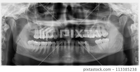 Detailed panoramic dental X-ray showing teeth structure. Detailed panoramic dental X-ray showing teeth structure. 113385238