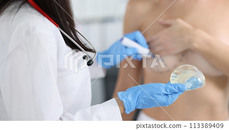 Plastic surgeon holding silicone breast implant and applying preoperative markings to patient chest closeup Plastic surgeon holding silicone breast implant and applying preoperative markings to patient chest closeup 113389409