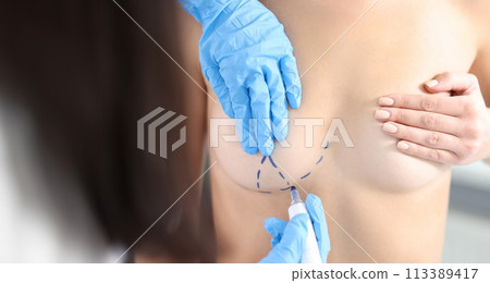 Plastic surgeon drawing preoperative markings on patient chest closeup 113389417