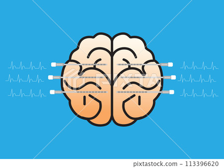 illustration of a brain with stereoelectroencephalography (SEEG) electrodes inserted in the brain for epilepsy diagnostic. illustration of a brain with stereoelectroencephalography (SEEG) electrodes inserted in the brain for epilepsy diagnostic. 113396620