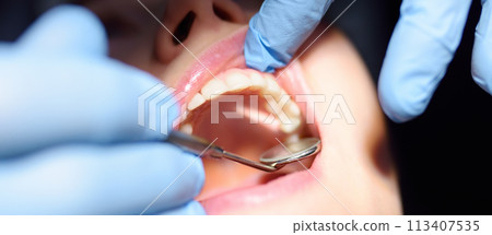 Dentist treats young woman teeth in hospital. Doctor Practitioner examines patient before orthodontists or prosthetics treatment at modern medical center. Close up view of teeth and hands. Banner Dentist treats young woman teeth in hospital. Doctor Practitioner examines patient before orthodontists or prosthetics treatment at modern medical center. Close up view of teeth and hands. Banner 113407535