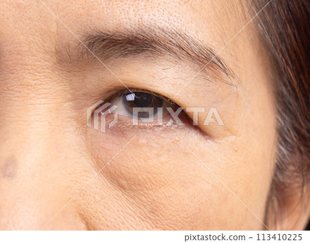 Flabby and wrinkled skin on senior woman face. 113410225