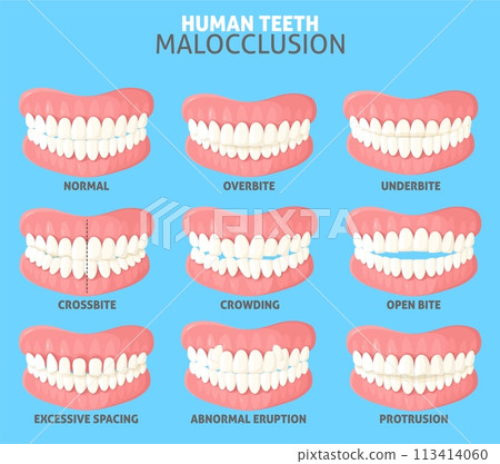 Different human teeth malocclusion types front view set 113414060
