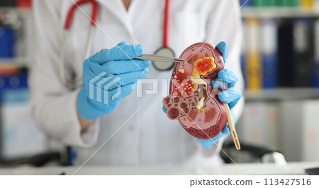 Urology and treatment of kidney diseases closeup 113427516