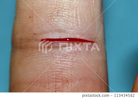 A finger cut A finger cut 113434582