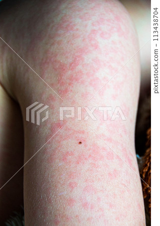 Viral disease. Measles rash on the body of the child. Allergy Viral disease. Measles rash on the body of the child. Allergy 113438704