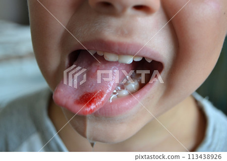 Child's bitten tongue Child's bitten tongue 113438926
