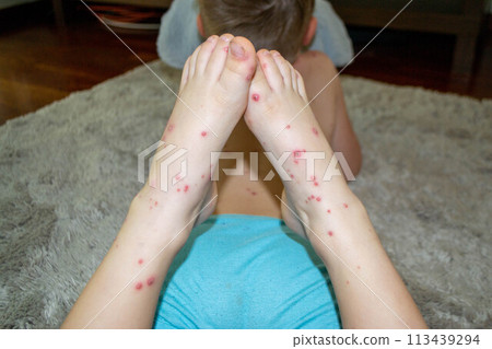 Natural vaccination. Contagious disease. Natural vaccination. Contagious disease. 113439294
