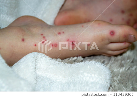 Natural vaccination. Contagious disease. 113439305