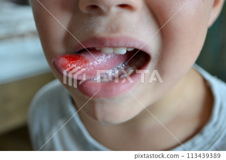 Child's bitten tongue 113439389