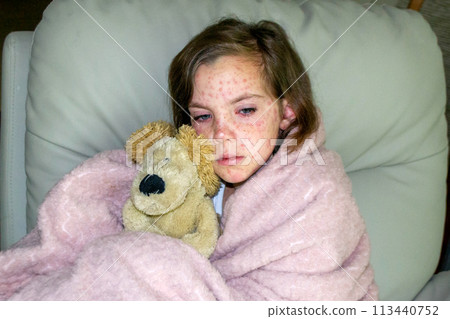 Natural vaccination. Contagious disease. Sick child with chickenpox. Natural vaccination. Contagious disease. Sick child with chickenpox. 113440752