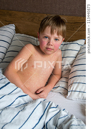 Viral disease. Measles rash on the body of the child. Allergy 113440873