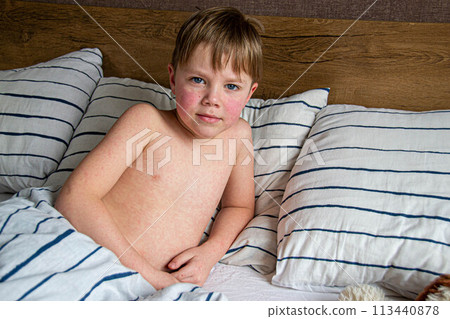 Viral disease. Measles rash on the body of the child. Allergy Viral disease. Measles rash on the body of the child. Allergy 113440878