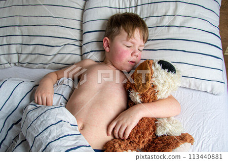 Viral disease. Measles rash on the body of the child. Allergy 113440881