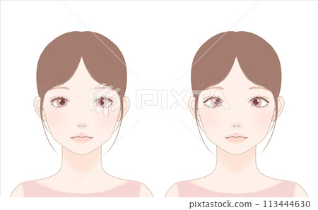雙眼皮手術前及術後 113444630