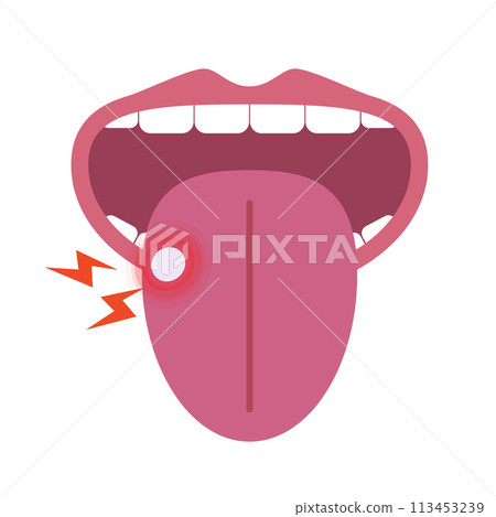 Stomatitis Stomatitis 113453239