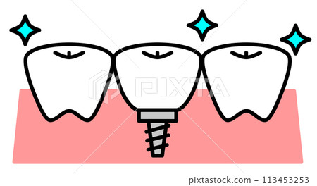 在牙醫處透過植牙治療替換牙齒的插圖 113453253