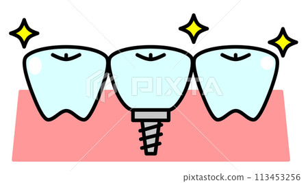 Illustration of teeth replaced by implant treatment at a dentist Illustration of teeth replaced by implant treatment at a dentist 113453256